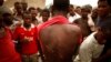 An Ethiopian migrant shows torture wounds he received from traffickers as he waits to be repatriated at a transit center in the western Yemeni town of Haradh, on the border with Saudi Arabia, Mar. 16, 2012.