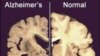 This undated image provided by Merck & Co., shows a cross section of a normal brain (right) and one of a brain damaged by advanced Alzheimer's disease, December 3, 2012