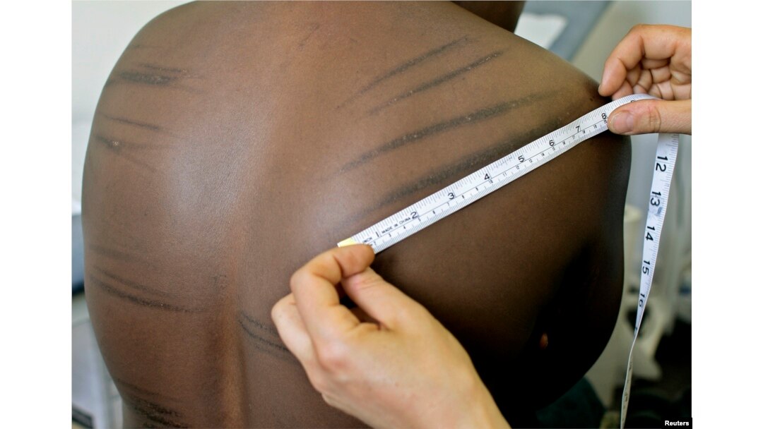 FILE - A torture sufferer from Uganda is examined by a doctor at the headquarters of Freedom From Torture, formerly known as the Medical Foundation for the Care of Victims of Torture, in London.