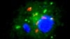 Mycobacterium tuberculosis (red) is hiding in human white blood cells (blue and green) cultured in vitamin D-deficient serum 