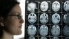 FILE - Kyla Nagel stands next to her brain scan at her home in Springfield, Ore. Nagel was diagnosed with an aggressive brain cancer.