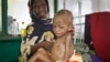 FILE - A malnourished five-year-old boy sits on his mother's lap at a hospital in Somalia, May 20, 2014. 