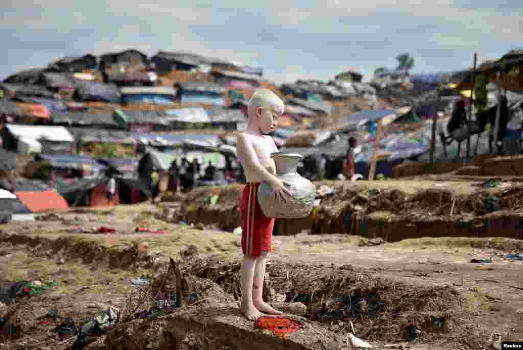 An albino Rohingya refugee poses for a picture in Cox's Bazar, Bangladesh.